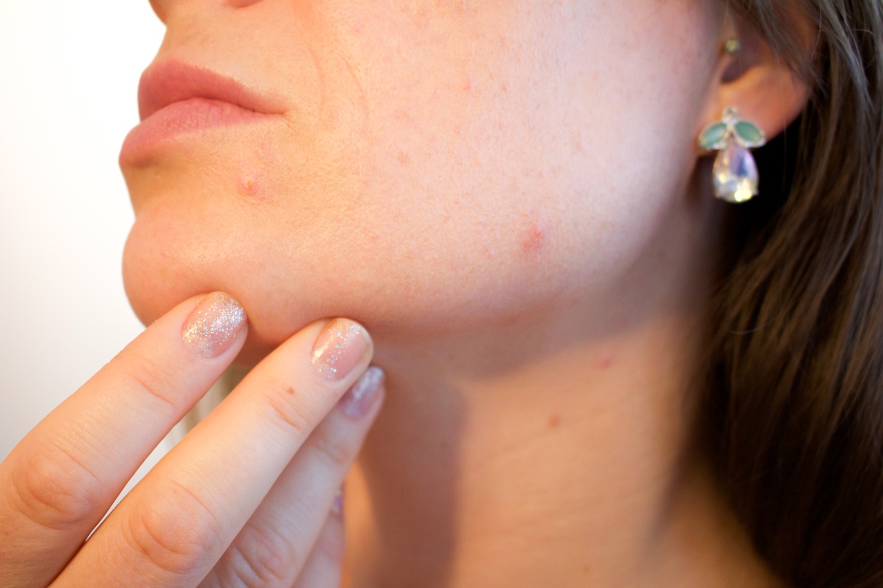 Problemhautbehandlungen bei unreiner Haut und begleitend bei Akne, Rosacea, Neurodermitis