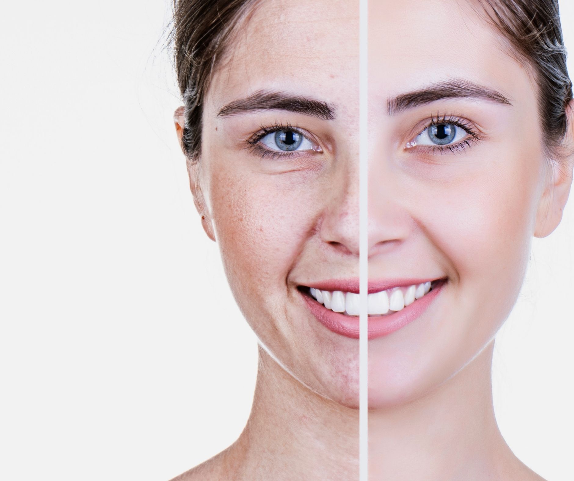 Vorher-Nachher-Foto des Gesichts einer Frau nach einer hochintensiven fokussierten Ultraschallbehandlung zur Hautstraffung und Anti-Aging.